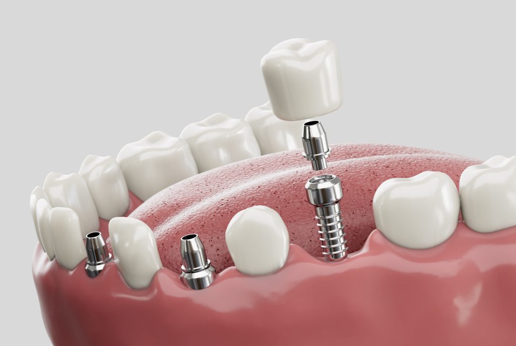 Dental implants for tooth replacement at Withers Dental