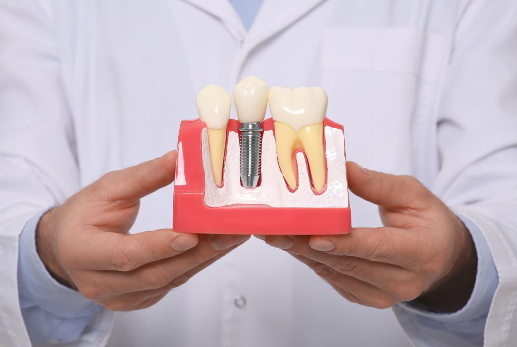 Types of dental implants in Manhattan Beach CA